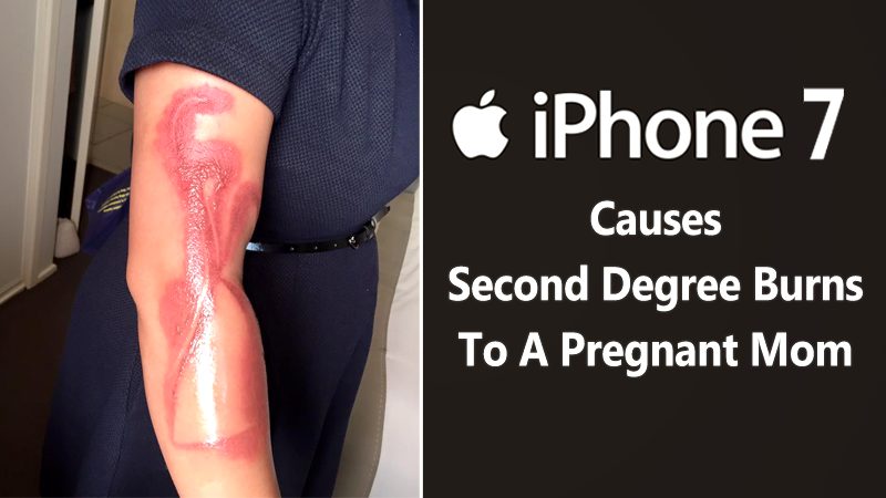 This is Not a Tattoo, Pregnant Mom Gets Second Degree Burns From Her iPhone 7